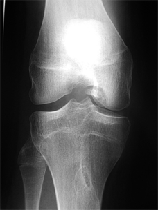 osteochondrite1