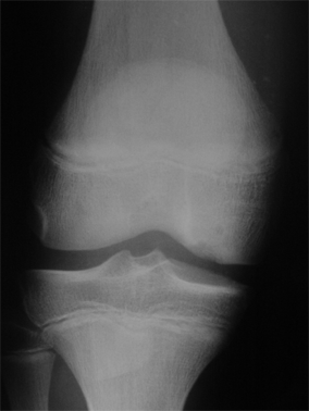 osteochondrite2