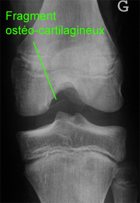 osteochondrite3