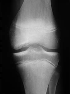 osteochondrite4