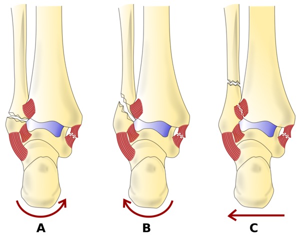 weber_classification_-_latin.svg.png