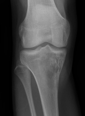 osteosarcoma-proximal-tibia-e1436371351424