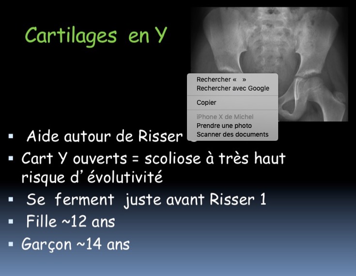 Cartilages en Y