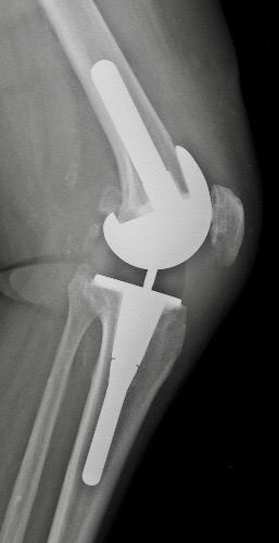 ptg-revision-lcck-orthopedie