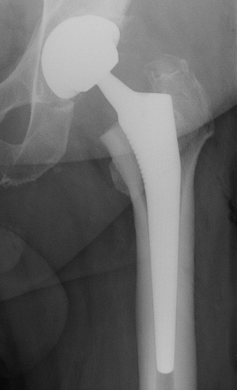 radio-prothese-hanche-ceramique-perigueux