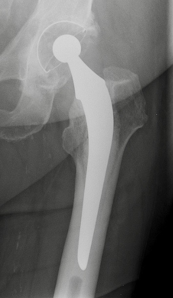 radio-prothese-hanche-cimentee