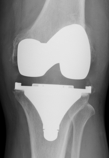 radio-prothese-totale-genou-dr-simian