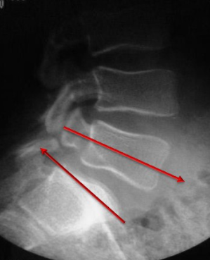 spondylolyse